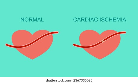  ilustración de la isquemia cardiaca vectorial plana