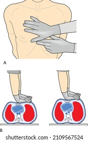 Cardiac Massage To An Unconscious Guy After Injury