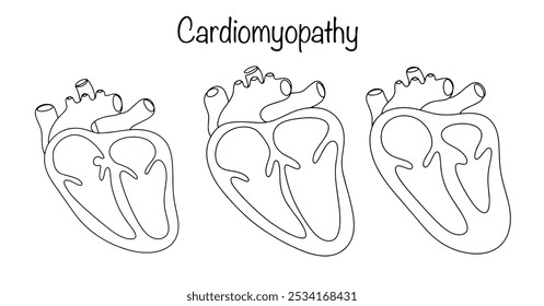 Herzpathologie, die von einer Vergrößerung des Herzens und einer Verdickung des Herzmuskels begleitet wird. Eine Linie gezeichnet gesundes Herz und zwei Herzen mit Symptomen der Kardiomyopathie. Vektorgrafik.