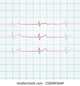 Cardiogram. Heart beat. Heartbeat line. Electrocardiogram. Vector
