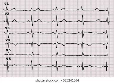 Cardiogram. Heartbeat. The graph on graph paper. Vector illustration.