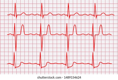 Cardiogram or Pulse Line on a Pink Grid Cardio Pulsating Trace Set. Vector illustration of Electrocardiogram Record