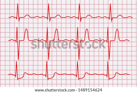 Cardiogram or Pulse Line on a Pink Grid Cardio Pulsating Trace Set. Vector illustration of Electrocardiogram Record