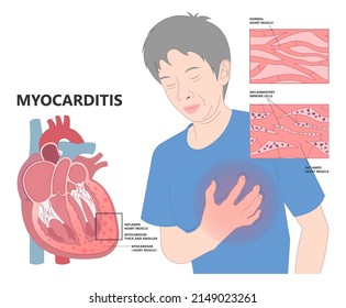 Cardiology High Blood Pressure Heart Attack MRNA Lupus Viral Vaccine ECG COVID-19 Virus ECMO Rapid Chest Pain Leg Ankles Feet Transplant Giant Cell Infectious