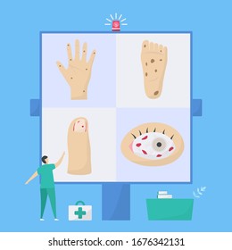 Cardiology vector illustration. This disease is endocarditis or heart infections. Symptoms includes osler nodes, nail bed hemorrhages and roth spots.