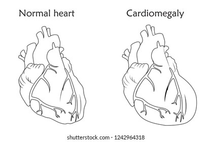 Cardiomegaly. Enlarged and normal heart muscles. Anatomy thin line flat illustration. Outline image, white background.