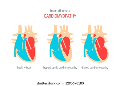 2,296 Cardiomyopathy Images, Stock Photos & Vectors | Shutterstock