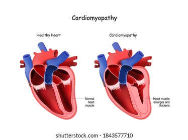 Kardiomyopathie. Gesundes Herz und Herz mit vergrößerten und verdickten Muskeln. Kreuzung des menschlichen Herzens