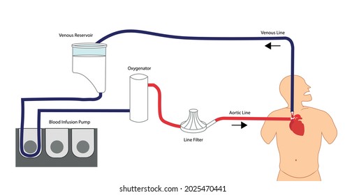 Cardiopulmonary Bypass. Extracorporeal Circulation. Support Technique For Cardiac Surgery. Machine Utilized For Heart And Lung Function
