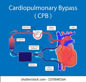 Cardiopulmonary bypass heart lung machine coronary oxygenator perfusiologist cardiologist operating life support artery graft circulation repair mitral  tricuspid pulmonic septal defect aneurysms aid