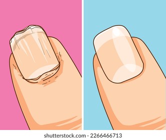 Care of natural nails. File the nail. Broken nail. Before, after. Healthcare illustration. Vector illustration.