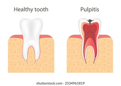 Career stages. Stages of tooth decay