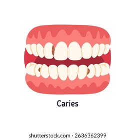 Caries, dental disease, bacteria, destruction of tooth enamel, poor oral hygiene