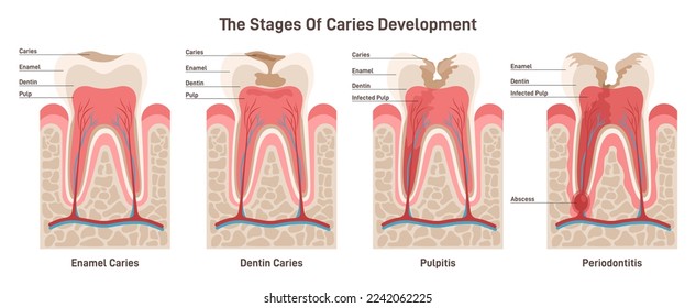 Caries development. Dental disease stages: enamel and dentin caries, pulpitis and periodontitis. Teeth structure decay. Oral cavity hygiene problem. Dental education poster. Flat vector illustration