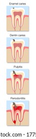 Caries development infographic, stages with cross section of tooth decay with enamel and dentin caries, pulpitis and periodontitis. Vector illustration on white.
