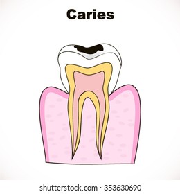 Caries. The formation of tooth decay healthy tooth