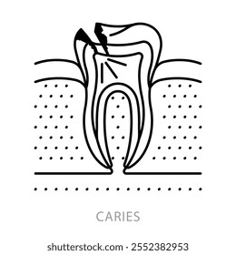 Caries, ícone de linha. Anatomia da cárie dentária - esmalte, polpa, osso, canal radicular, coroa, ruptura, a cavidade. Problema de odontologia e cuidados dentários. Conceito de estomatologia. Ilustração linear, ícone de traçado editável