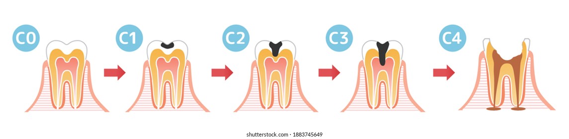 Caries and Progression and Treatment: Dental Illustration