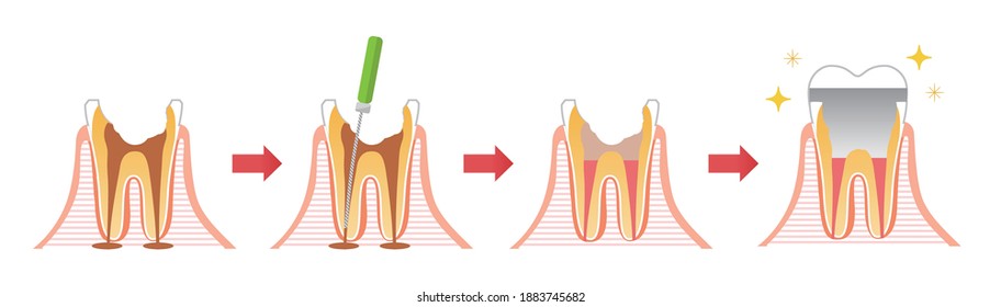 Caries and Progression and Treatment: Dental Illustration