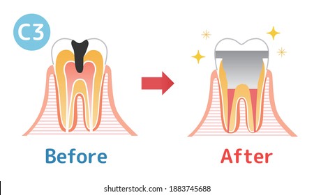Caries and Progression and Treatment: Dental Illustration