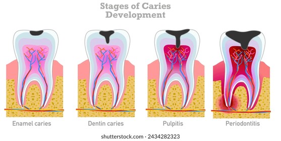 Caries stages development. Tooth decay enamel, dentin caries, pulpitis, periodontitis chart. Medical , dental pain. Illustration vector