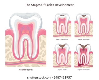 Caries stages. Human decay teeth progress, dental problem oral cavity gum infection abscess pulpitis dead tooth root canal disease periodontal erosion, swanky vector illustration