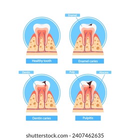 Caries Stages Infographics. Healthy Tooth, Enamel Caries, Dentin Caries, and Pulpitis Cross Section View, Medical Visual