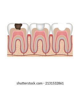 Caries. Stages of treatment of a tooth with a filling. Vector illustration