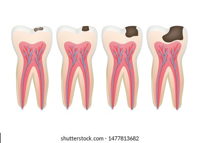 Caries tooth. Decay pulpit dental problem procedure root vector tooth medical pictures