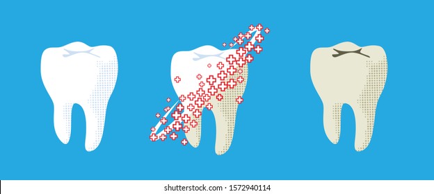 Caries or tooth decay treatment concept. Bad unhealthy and white healthy tooth. Cleaning and whitening teeth