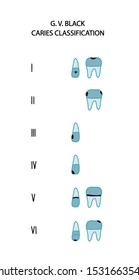 Caries type classification black six hand drawn vector illustration in cartoon comic style crown roots form