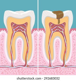 Carious human tooth cross section