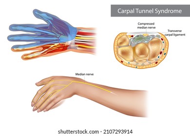 Síndrome del túnel carpiano. Nervio medio comprimido. Anatomía del túnel carpiano, mostrando el nervio medio.