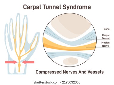 Carpal Tunnel Syndrome. Compressed Median Nerve. Carpal Tunnel Anatomy. Sensations Of The Fingers, Thumb And Palm. Flat Vector Illustration