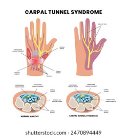 Carpal Tunnel Syndrome diagram poster infographic banner, diagram closeup with muscle, transverse carpal ligament, median nerve, tendon sheath, flexor tendons and bones, Carpal tunnel scheme.