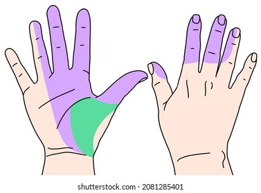 Carpal Tunnel Syndrome. Median Nerve Vector Illustration Doodle Style