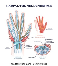 Carpal tunnel syndrome with median nerve pressure disease outline diagram. Labeled educational orthopedic condition from working with non ergonomic computer vector illustration. Occupational arm pain.