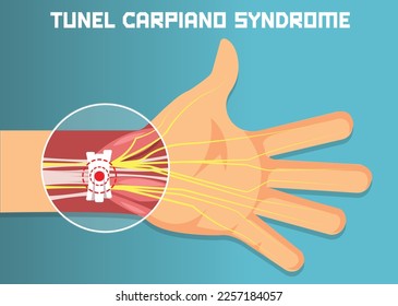 Carpal Tunnel Syndrome. office hand syndrome