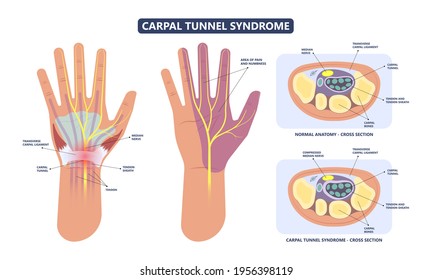 Carpal Tunnel Syndrome pain hand arm wrist splint surgery bone flexor fingers thumb muscle Brace index middle ring work limb palm mouse keyboard