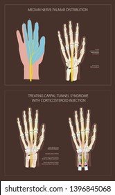 Carpal Tunnel Syndrome - Treating With Corticosteroid Injection - Vector Illustration With Description