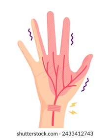 Carpal tunnel syndrome vector illustration