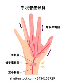 Síndrome del túnel carpiano ilustración vectorial. Traducción: Síndrome del túnel carpiano, entumecimiento, túnel carpiano, ligamento, nervio mediano.