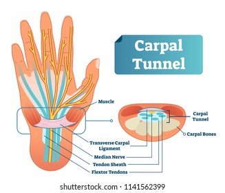 Carpal tunnel vector illustration scheme. Medical labeled diagram closeup with isolated muscle, transverse carpal ligament, median nerve, tendon sheath, flextor tendons and bones. Job and work illness