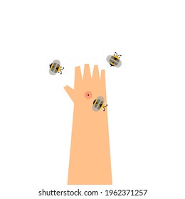 Cartoon Of A Bee Sting At Hand.