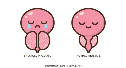 Cartoon Benign And Prostate Vector Illustration. Icon Character Of Male Urology Inflammation Disease. Flat Design For Diagram, Medical Journal Article. Prostatitis, Enlarged,obstruction,hypertrophy