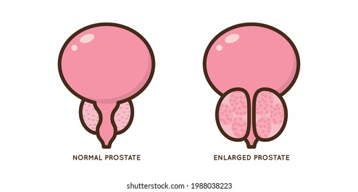 Cartoon Benign And Prostate Vector Illustration. Icon Character Of Male Urology Inflammation Disease. Flat Design For Diagram, Medical Journal Article. Prostatitis, Enlarged,obstruction,hypertrophy