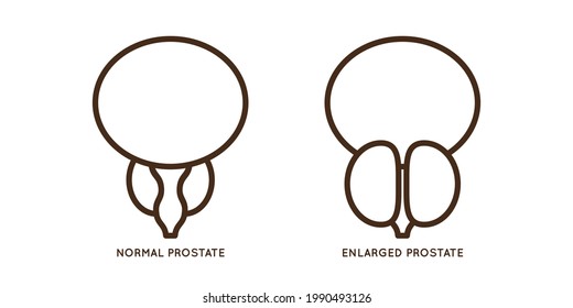 Cartoon Benign And Prostate Vector Illustration. Icon Character Of Male Urology Inflammation Disease. Flat Design For Diagram, Medical Journal Article. Prostatitis, Enlarged,obstruction,hypertrophy