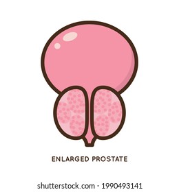 Cartoon Benign And Prostate Vector Illustration. Icon Character Of Male Urology Inflammation Disease. Flat Design For Diagram, Medical Journal Article. Prostatitis, Enlarged,obstruction,hypertrophy