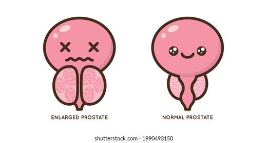 Cartoon Benign And Prostate Vector Illustration. Icon Character Of Male Urology Inflammation Disease. Flat Design For Diagram, Medical Journal Article. Prostatitis, Enlarged,obstruction,hypertrophy