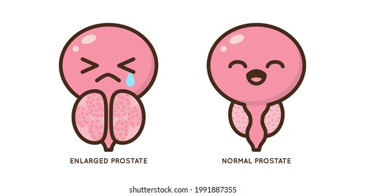 Cartoon Benign And Prostate Vector Illustration. Icon Character Of Male Urology Inflammation Disease. Flat Design For Diagram, Medical Journal Article. Prostatitis, Enlarged,obstruction,hypertrophy